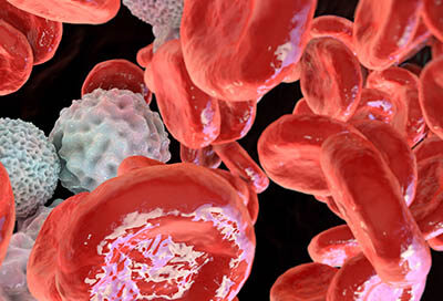 Polycythemia vera, a rare slow-growing blood cancer with an increase in the number of red blood cells in the body, 3D illustration showing abundant erythrocytes inside blood vessel