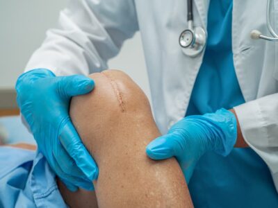 stem cell therapy